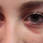 Face with eye discolouration due to hay fever